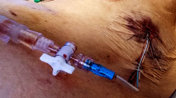 Treating a collapsed lung.